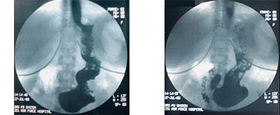 Ακτινολογική εικόνα στομάχου 3 μήνες μετά από λαπαροσκοπική γαστροπτύχωση. Ο περιορισμός της χωρητικότητας είναι εμφανής.